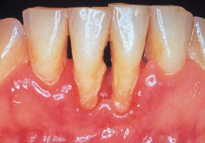 Tụt lợi chân răng có chữa được không? Câu trả lời TẠI ĐÂY!